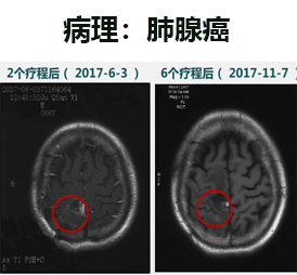 CART细胞治疗案例