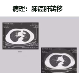 CART细胞治疗案例