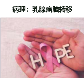CART细胞治疗案例