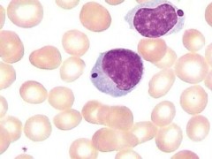 T细胞-急性淋巴细胞白血病分子遗传学改变和靶向治疗新进展