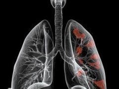 《中国原发性肺癌诊疗规范（2015年版）》全文及专家解读