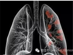 我国将启动肺癌免疫治疗药物Nivolumab三期临床试验！