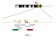 好消息！膀胱癌复发的元凶“MLL基因”已找到！