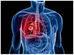 招募临床试验：AZD9291治疗局部晚期或转移性非小细胞肺癌