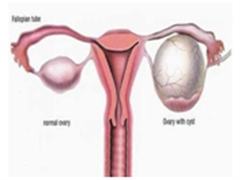 新药Pembrolizumab(Keytruda)(MK-3475)治疗晚期复发性卵巢癌女性患者