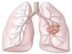 招募临床试验：Brigatinib治疗难治性ALK重排的非小细胞肺癌