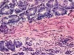 解读Keynote-012：PD-L1抑制剂在晚期胃癌中初步显示阳性结果