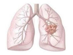 新一代肺癌治疗药物olmutinib在韩国率先获批