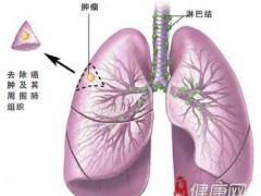 小细胞肺癌研究进展 靶向药或可扭转晚期NCLC治疗困局