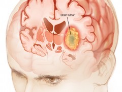 科学家发现脑瘤治疗潜在的靶标，或可有效预防复发