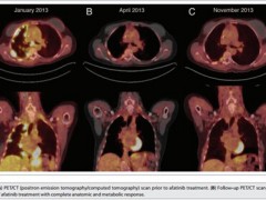 震惊 EGFR阴性的晚期肺腺癌患者是如何找到7种靶向药物的？