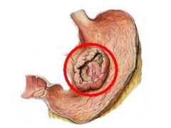 【ASCO GI】胃癌D2根治手术或废弃网膜囊切除