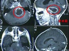 胶质瘤质子治疗 一个月后复查 肿瘤明显缩小 症状改善