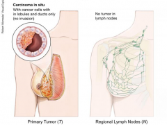 乳腺癌的分期和分型