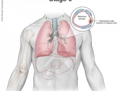 肺癌分期和分型