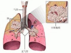 晚期非小细胞肺癌新希望，TCR-T细胞临床试验招募！