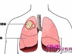 肺癌分为哪几种？
