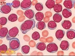 急性白血病与慢性白血病的“三系细胞变化”