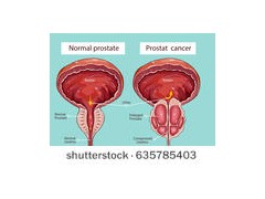 前列腺癌根治切除术后淋巴结阳性患者 不同术后治疗策略的生存结果分析研究