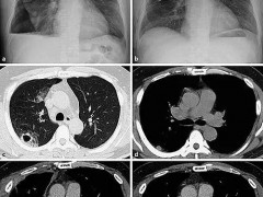 PD-1成功治疗肺多形性癌：首例报告！
