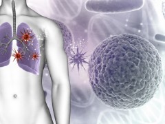 TTF联合化疗提高了晚期非小细胞肺癌患者的生存率