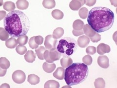 【抗癌日报】全球抗癌动态--首个国产PD-1单抗申请上市、新疗法可降低83%白血病进展风险！