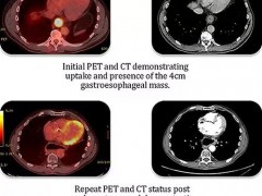 病例报道：转移性胃食管癌患者使用赫赛汀效果显著