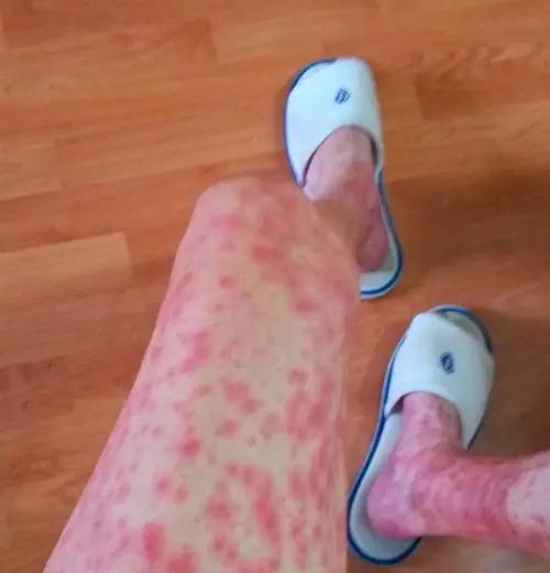 服用靶向药后腿部的不良反应,皮疹和皮肤脱落