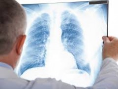 肺癌靶向治疗～ AZD9291（奥希替尼 ）