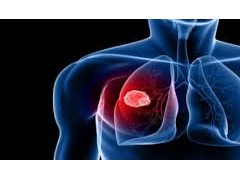我国首个获批的第三代肺癌靶向药物奥希替尼（泰瑞沙）正式在国内上市