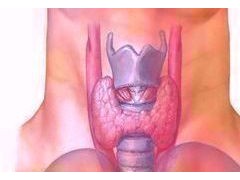 甲状腺乳头状癌双侧病变患者的预后更差