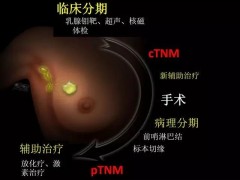 乳腺癌诊疗流程你了解多少