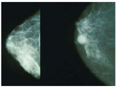研究发现：乳腺癌发生转移的“遗传种子”