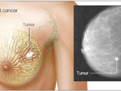 乳腺癌研究|基因测序指导个体化治疗势在必行