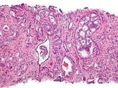 前列腺癌新药问世 平均疾病无进展时间达40多个月
