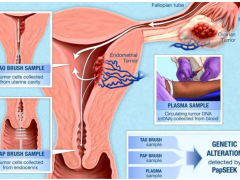 新研究|宫颈癌巴氏涂片标本可通过基因检测筛查其他妇科癌症