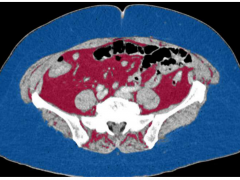 女性肾癌患者要注意腹部脂肪量 这可能是夺命因素