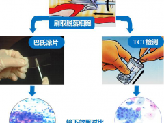 宫颈癌TCT检测比巴氏涂片更为先进、准确率高