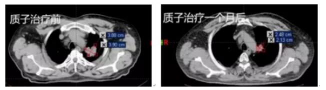 质子治疗案例