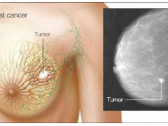 血癌药物对致命性三阴乳腺癌有效？？