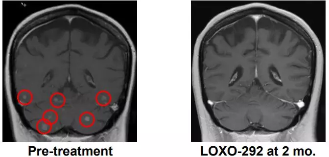 LOXO-292