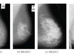 X射线下乳腺癌到底长什么样子？