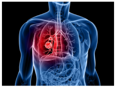 现有的治疗方法可以用来治疗常见的“无法无进展生存”的肺癌