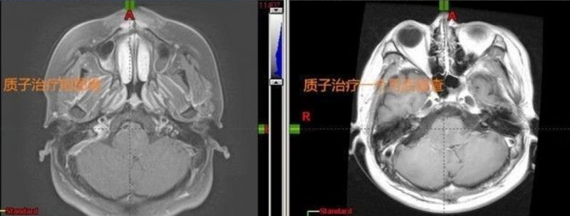 质子治疗前后对比