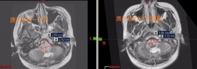 治疗后九个月复查