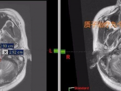 脑胶质瘤质子治疗,胶质瘤质子治疗效果,胶质瘤质子治疗成功案例