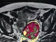 突破性新药对标准治疗失败的肺癌卵巢癌显示出令人兴奋的治疗效果