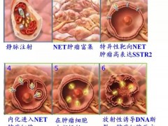 害死乔布斯的难治性肿瘤——神经内分泌瘤有了新疗法PRRT！