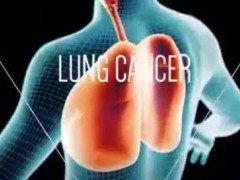 史上！肺癌靶点全面解读及对应靶向药物方案盘点！（2018）