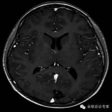 脑转移瘤治疗后